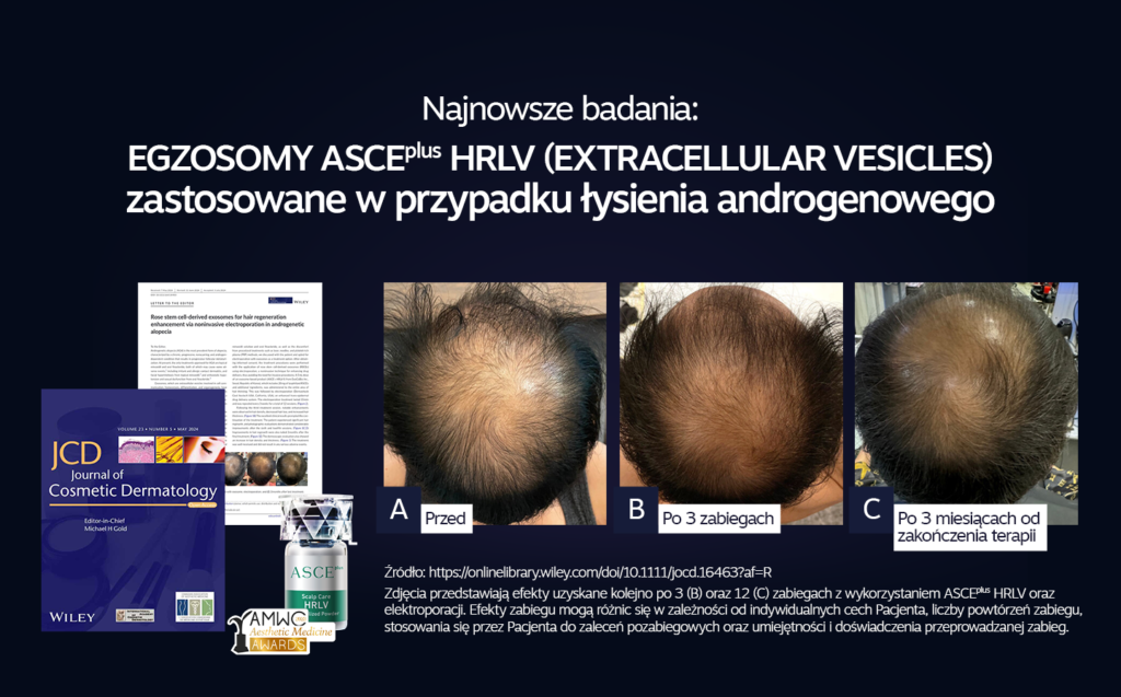 łysenie androgenowe egzosomy
